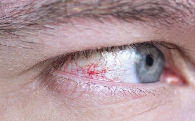 Prasknutá cievka v oku: Zisti príčinu a neignoruj signály tela!