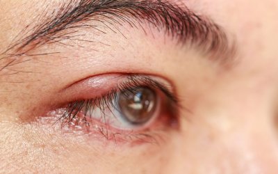 Jačmeň na oku: Ako sa ho zbaviť domácou liečbou?