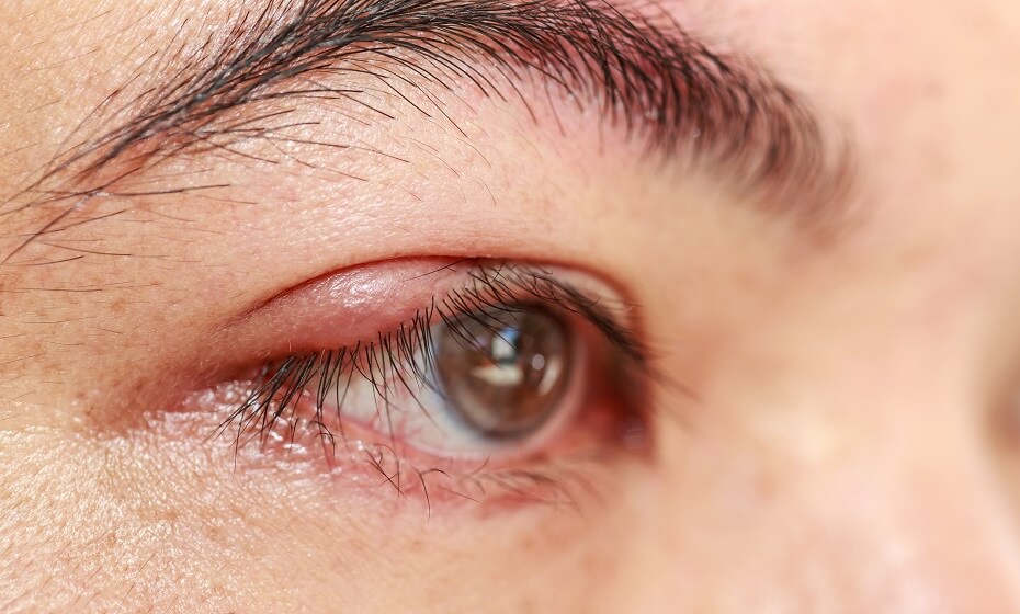 Jačmeň na oku: Ako sa ho zbaviť domácou liečbou?