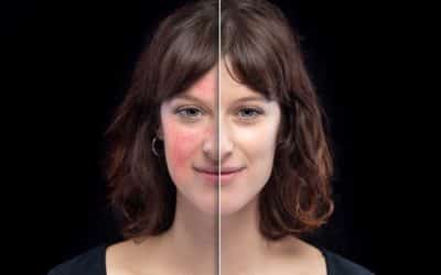 Najlepší rosacea krém a ďalšia overená TOP kozmetika na ružovku